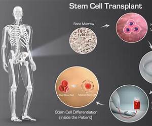 Stem Cell Transplant!: The Ultimate Unfiltered Patient Guide